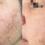 Lesioni da acne - Prima e Dopo